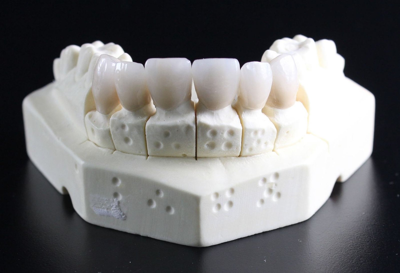 A dental model showing porcelain crowns, the kind of repair an emergency crown visit can start